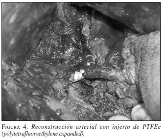 Reconstrucción Arterial con Injerto de PTFE