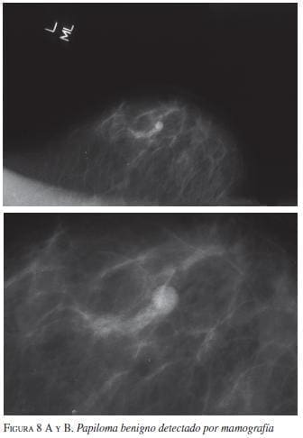 papiloma intraquistico benigno