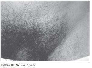Hernia Directa