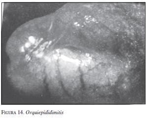 Orquiepididimitis
