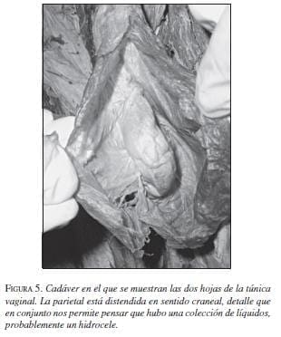 Cadáver en el que se muestran las dos hojas de la Túnica Vaginal