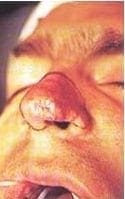 Resección de lesión nasal