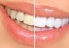 Blanqueamiento de Dientes, Estético, pero También muy Peligroso