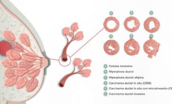 Carcinoma Ductal in Situ de Mama
