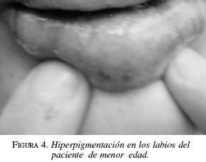 Hiperpigmentación en los Labios del Paciente de Menor de Edad