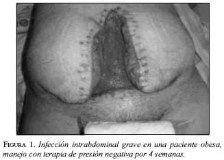 Infección Intrabdominal Grave en una Paciente Obesa