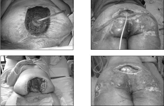 Úlceras de Decúbito Grado IV Manejadas con Desbridamiento Quirúrgico