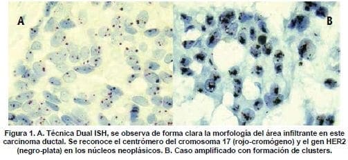 Técnica Dual ISH, Forma Clara la Morfología del Área Infiltrante en este Carcinoma Ductal
