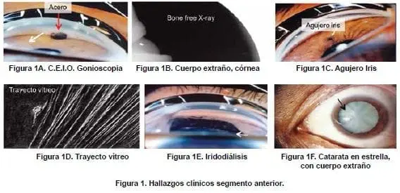 Trauma Ocular, Hallazgos clínicos segmento anterior