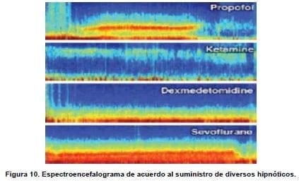 Espectroencefalograma de acuerdo al suministro de diversos hipnóticos