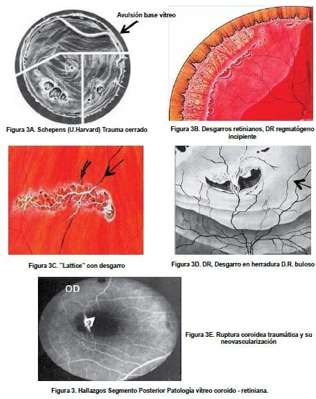 Hallazgos Segmento Posterior Patología vítreo coroido - retiniana