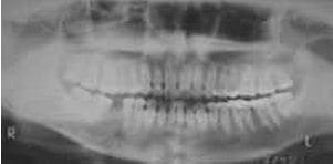 Radiografía panorámica, descarta dientes incluidos