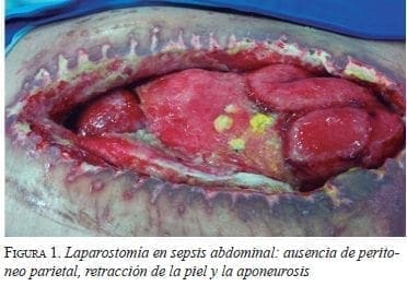 Laparostomía en Sepsis Abdominal