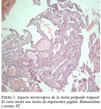 Aspecto Microscópico de la Lesión Polipoide Traqueal