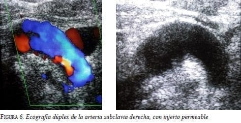 Ecografía Dúplex de la Arteria Subclavia Derecha, con Injerto Permeable