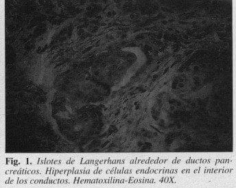 Nesidioblastosis, Islotes de Langerhans