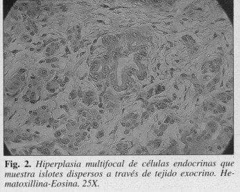 Hiperplasia Multifocal de Células Endocrinas
