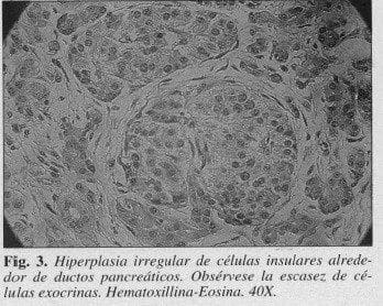 Hiperplasia Irregular de células Insulares