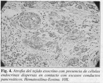 Atrofia del tejido Exocrina con presencia de Células Endocrinas