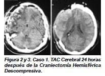 TAC Cerebral 24 horas después de la Craniectomía Hemisférica Descompresiva