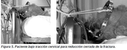 Paciente bajo Tracción Cervical