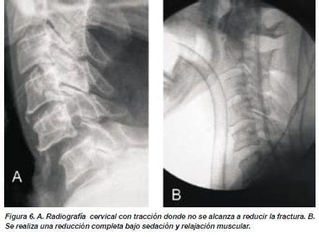 Radiografía Cervical con Tracción donde no se Alcanza a Reducir la Fractura