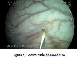 Gastrotomía Endoscópica
