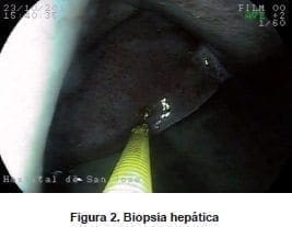 Biopsia Hepática