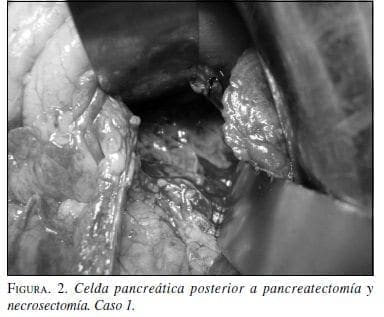 Celda Pancreática Posterior a Pancreatectomía y Necrosectomía. Caso 1