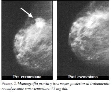 Mamografía Previa y tres meses posterior al Tratamiento Neoadyuvante