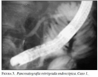 Pancreatografía Retrógrada Endoscópica. Caso 1