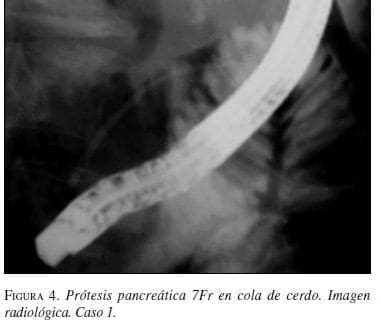Prótesis  Pancreática 7Fr en cola de cerdo