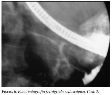 Pancreatografía Retrógrada Endoscópica. Caso 2.
