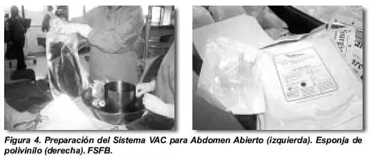 Preparación Sistema VAC para Abdomen Abierto