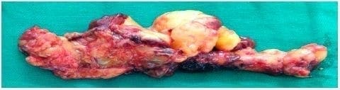Pieza quirúrgica de suprarrenalectomía
