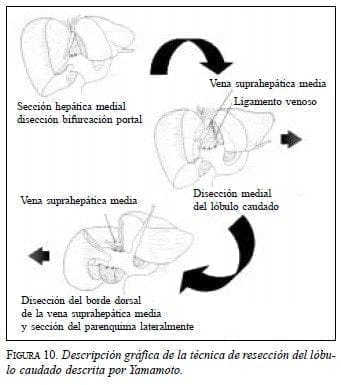 Técnica de Resección del Lóbulo Caudado descrita por Yamamoto