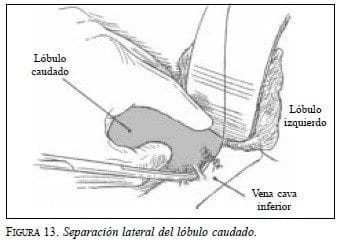 Separación lateral del Lóbulo Caudado