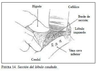 Sección del Lóbulo Caudado