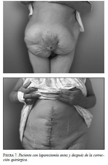 Paciente con Laparostomía antes y después de la Corrección Quirúrgica