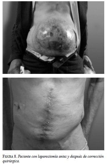 Paciente con Laparostomía antes y después de corrección Quirúrgica