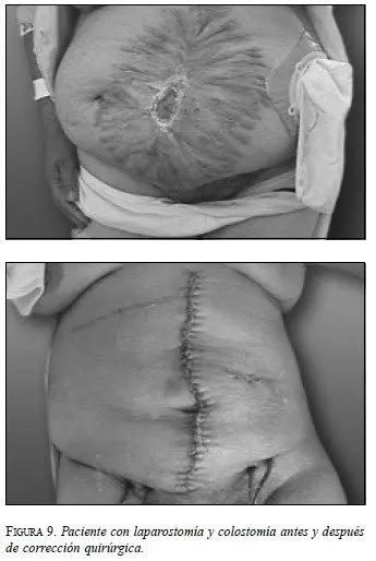 Paciente con Laparostomía y Colostomía antes y después de corrección Quirúrgica