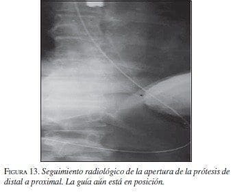 Seguimiento Radiológico de la Apertura de la Prótesis de Distal a Proximal