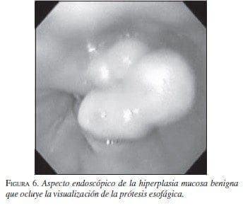Aspecto Endoscópico de la Hiperplasia Mucosa Benigna