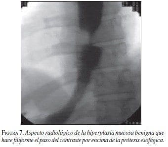 Aspecto Radiológico de la Hiperplasia Mucosa Benigna