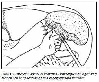 Disección Digital de la Arteria y Vena Esplénica, Ligadura y Sección
