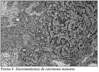Macrometástasis de carcinoma mamario