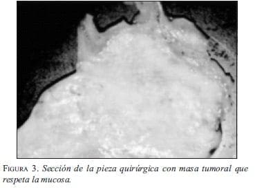 Sección de la Pieza Quirúrgica con Masa Tumoral que respeta la Mucosa
