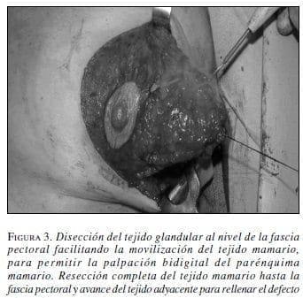 Disección del Tejido Glandular al nivel de la Fascia Pectoral