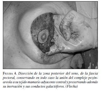 Disección de la zona posterior del seno