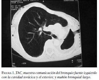 TAC, muestra comunicación del bronquio fuente izquierdo